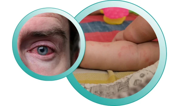 A person eye is seeing in image which has severe allergy problem