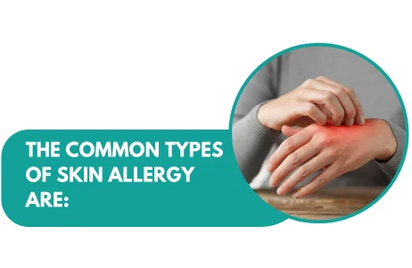 A red spot is occurs on the hand of a allergy patient