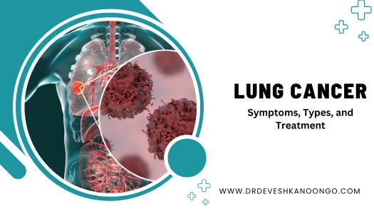 lung cancer