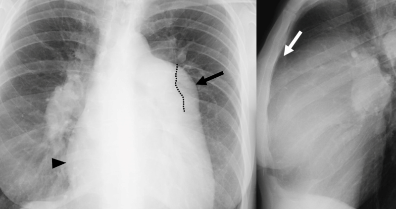 X-ray diagram of Pulmonary Hypertension