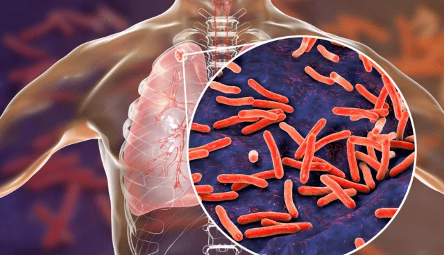 what is tb disease