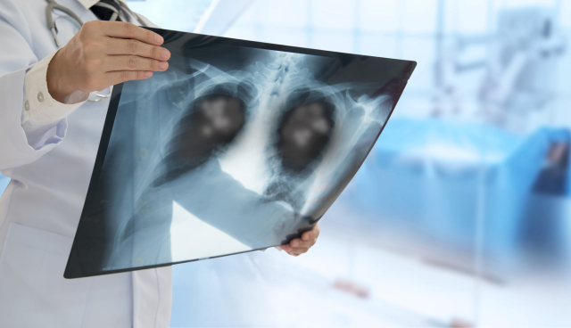 A doctor is seeing the x-ray of patient which is suffering from pneumonia